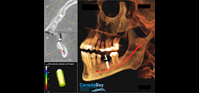 Implant Simulation