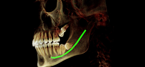 Left Buccal View