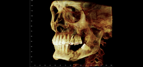 Osteomyelitis