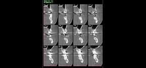 Slices Showing Bone Measurements